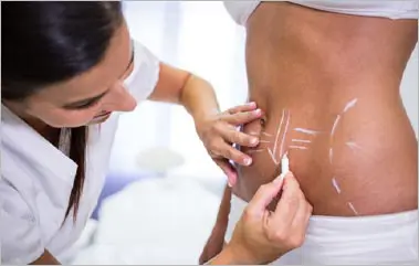 abdominoplastia cicatriz abdominoplastia cicatriz
