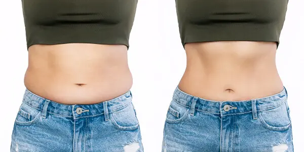 abdominoplastia