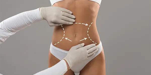 abdominoplastia