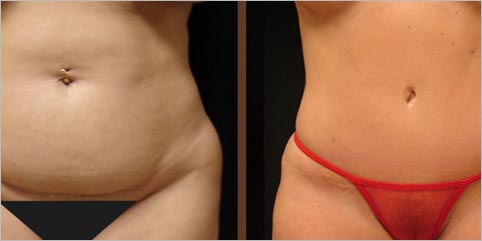 abdominoplastia antes e depois